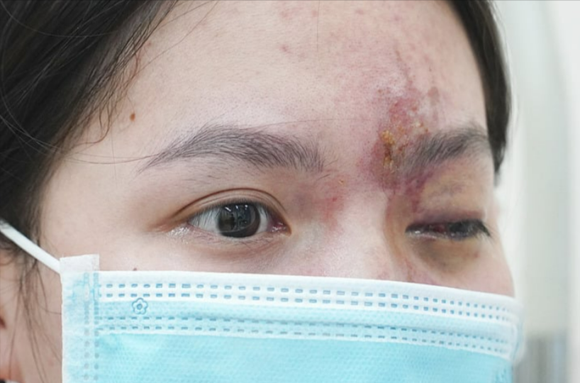 Mädchen erblindet nach Schönheits-OP! Klinik hatte gar keine Lizenz!